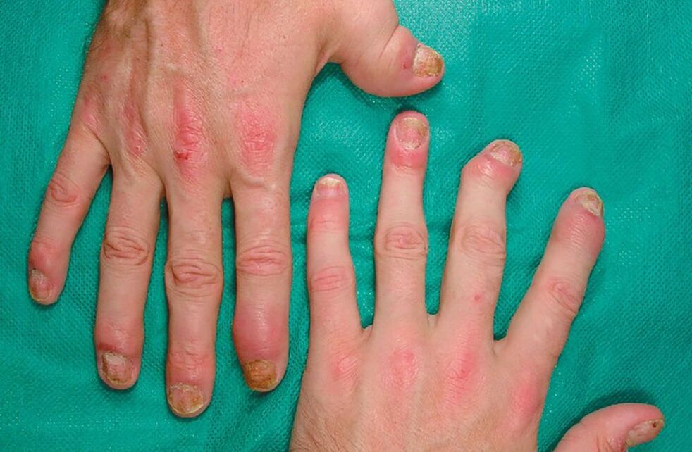 allergy na may mga parasito sa katawan